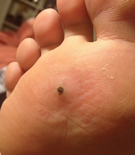 Brown Spots Under Skin On Bottom Of Feet